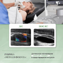 Рубрика «Метод в фокусе»: Дуплексное сканирование — «золотой стандарт» в предотвращении инсульта